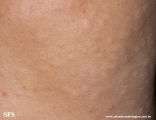 anetoderma jadassohn pellizari