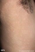 anetoderma jadassohn pellizari