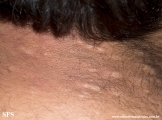 anetoderma jadassohn pellizari