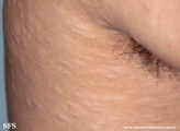 anetoderma jadassohn pellizari