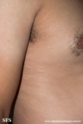 anetoderma jadassohn pellizari