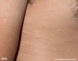 anetoderma jadassohn pellizari