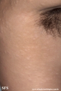 anetoderma jadassohn pellizari