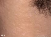 anetoderma jadassohn pellizari