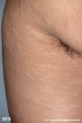 anetoderma jadassohn pellizari