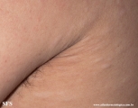 anetoderma jadassohn pellizari