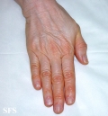 carotenaemia