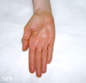 carotenaemia