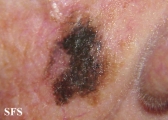 lentigo maligna-melanoma