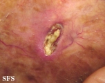 secondary cutaneous ossification