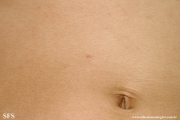 scabies