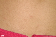 scabies