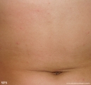scabies