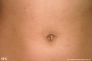 scabies
