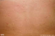 scabies