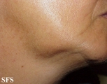 lymphoma-non hodgkin's lymphoma