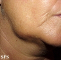 lymphoma-non hodgkin's lymphoma