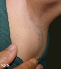 lymphoma-non hodgkin's lymphoma