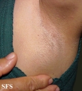 lymphoma-non hodgkin's lymphoma