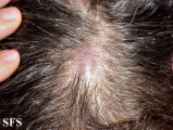 lymphoma-non hodgkin's lymphoma