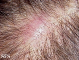 lymphoma-non hodgkin's lymphoma