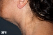 lymphoma-non hodgkin's lymphoma