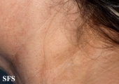 lymphoma-non hodgkin's lymphoma
