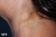 lymphoma-non hodgkin's lymphoma