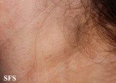 lymphoma-non hodgkin's lymphoma