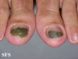 green nails-pseudomonas aeruginosa