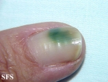 green nails-pseudomonas aeruginosa