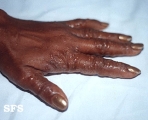 dyshidrotic eczema