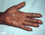 dyshidrotic eczema