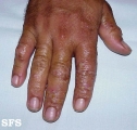dyshidrotic eczema