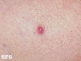 fibroxanthoma-atypical fibroxanthoma