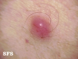 fibroxanthoma-atypical fibroxanthoma