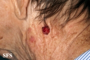 fibroxanthoma-atypical fibroxanthoma
