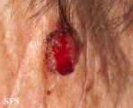 fibroxanthoma-atypical fibroxanthoma