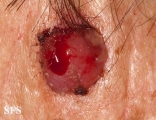 fibroxanthoma-atypical fibroxanthoma