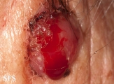 fibroxanthoma-atypical fibroxanthoma