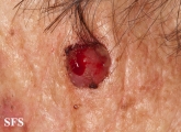 fibroxanthoma-atypical fibroxanthoma