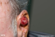 fibroxanthoma-atypical fibroxanthoma