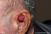 fibroxanthoma-atypical fibroxanthoma