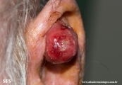 fibroxanthoma-atypical fibroxanthoma