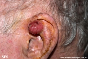 fibroxanthoma-atypical fibroxanthoma