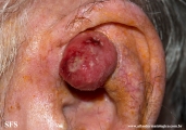 fibroxanthoma-atypical fibroxanthoma
