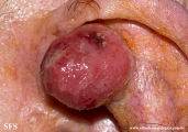 fibroxanthoma-atypical fibroxanthoma