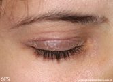 nail polish dermatitis