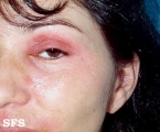 nail polish dermatitis