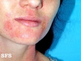 nail polish dermatitis